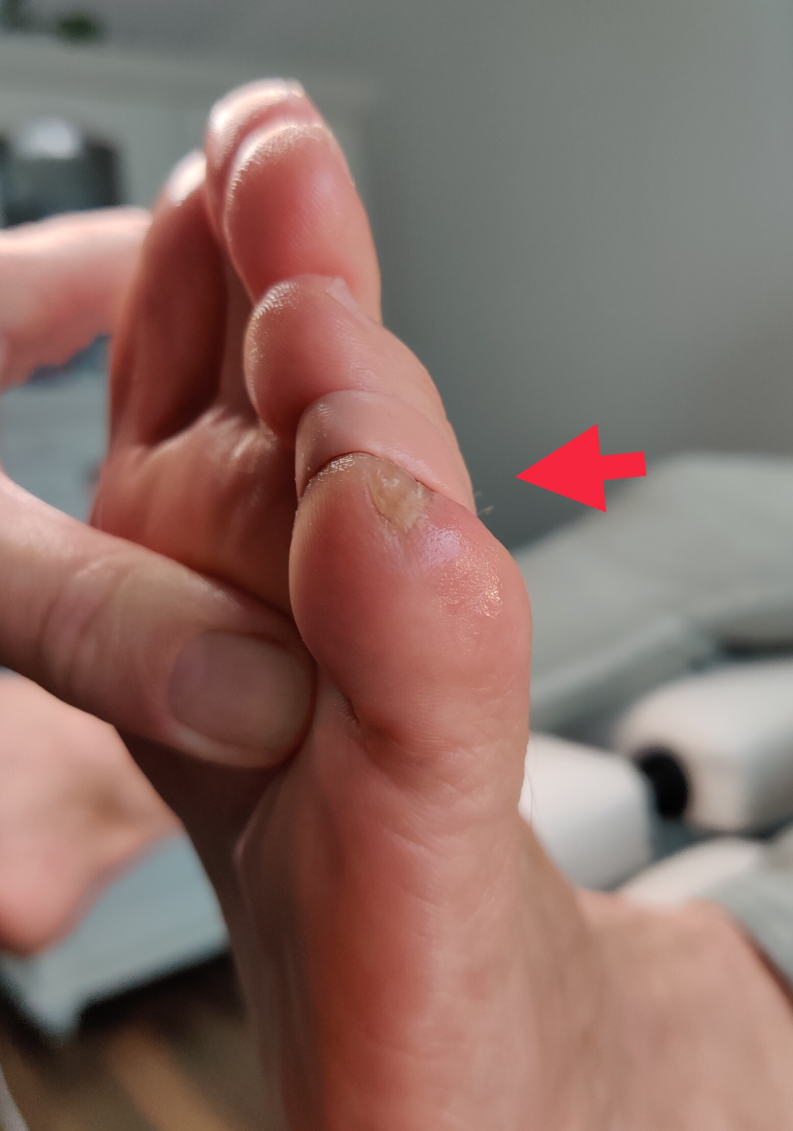 ingroeiende ingegroeide nagel teennagel pedicure Tilburg Udenhout Oisterwijk Berkel-Enschot Loon op Zand