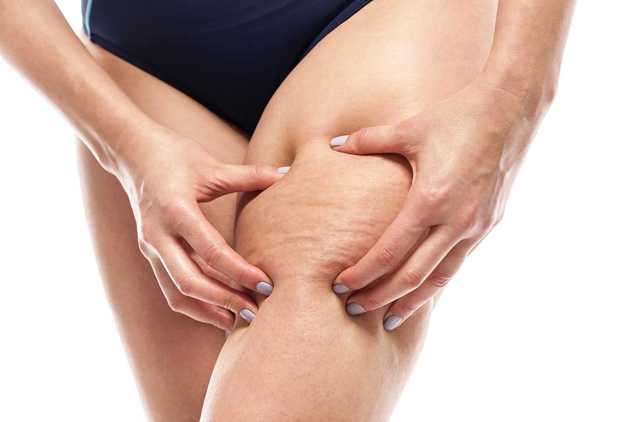 1590529579-0-i-rimedi-migliori-per-combattere-la-cellulite-standard-dlaimo.jpg