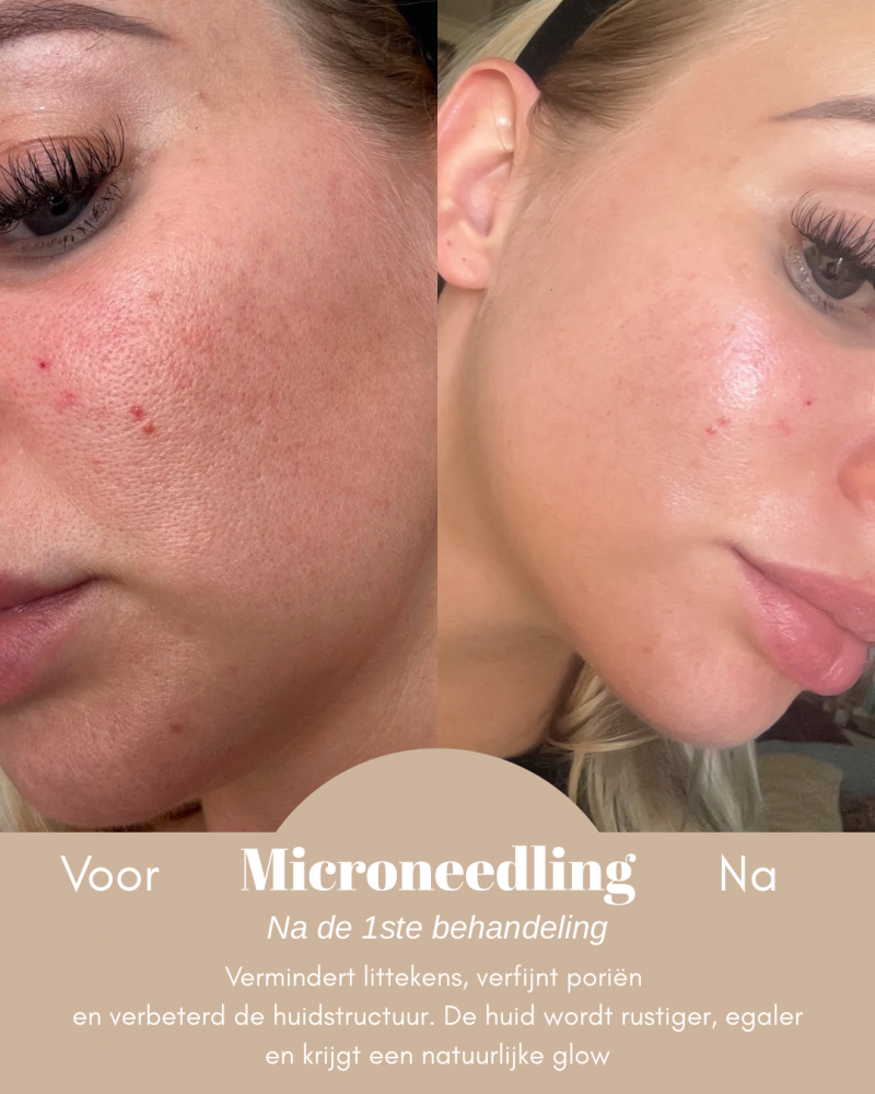 Microneedling Leerdam