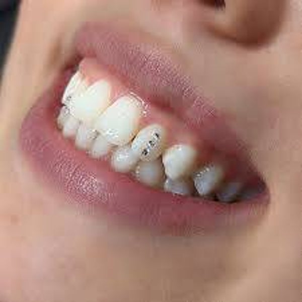 3X Swarovski Toothgems