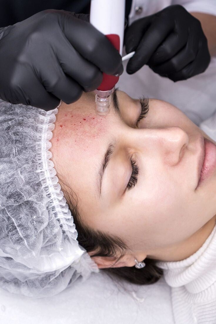 Limpieza Facial Profunda + Dermapen