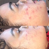before-and-after-chemical-peels-lighter-skintone-standard.jpg