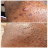 chemical-peel-before-and-after-dark-skintone-standard.jpg