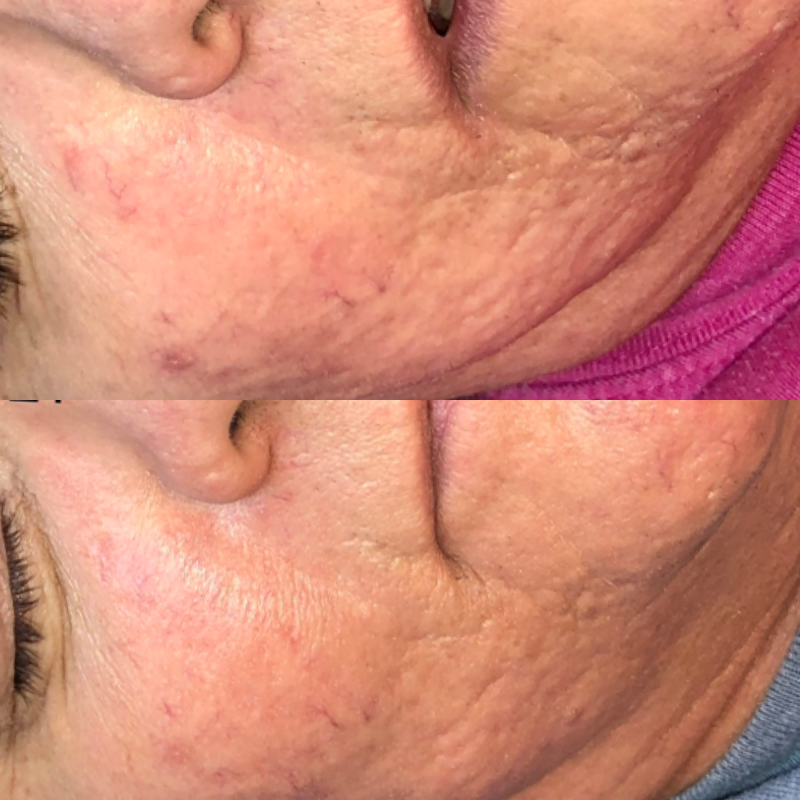 Before &amp; After 3 Micro-needling treatments