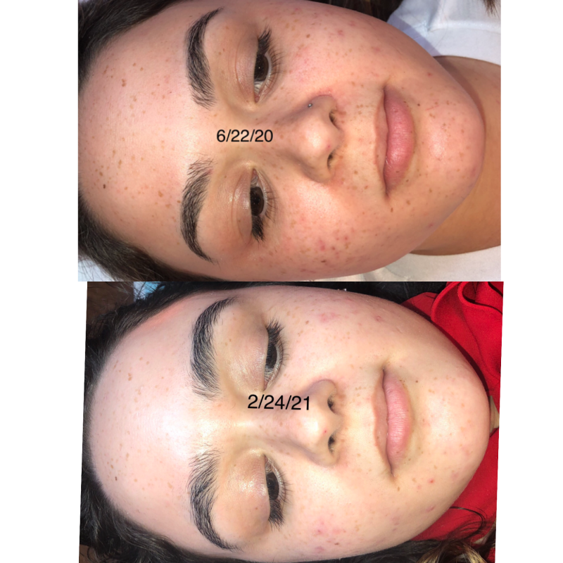 Before &amp; After 1 Micro-needling &amp; 5 Chemical Peels