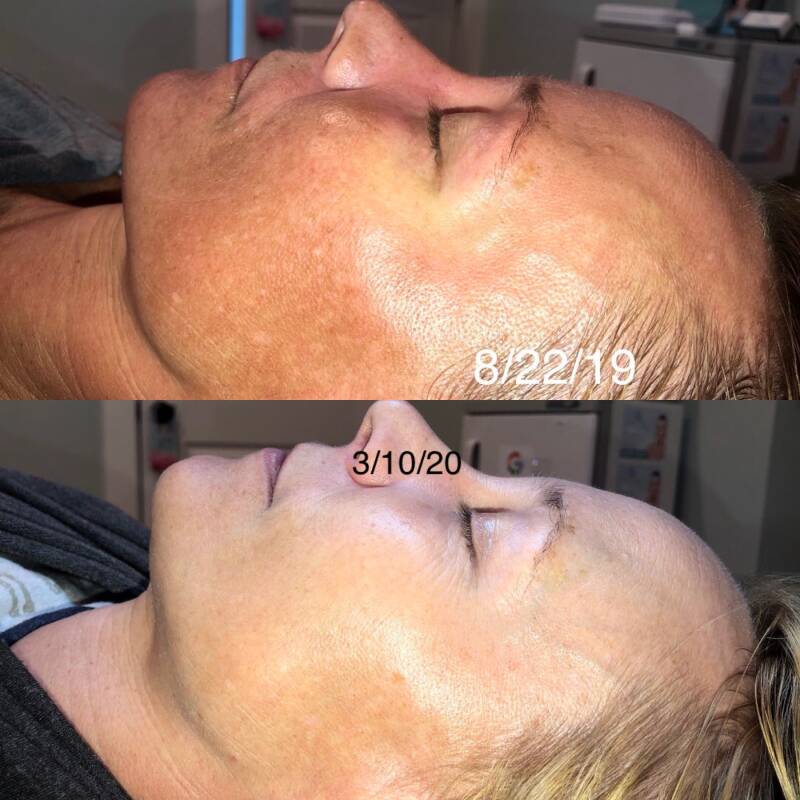 Before &amp; After 2 Perfection Lift Forte Peels