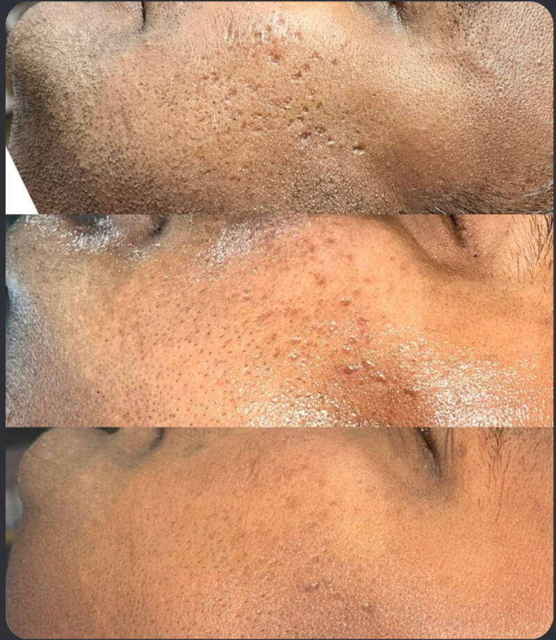 Before &amp; After 4 Micro-needling treatments