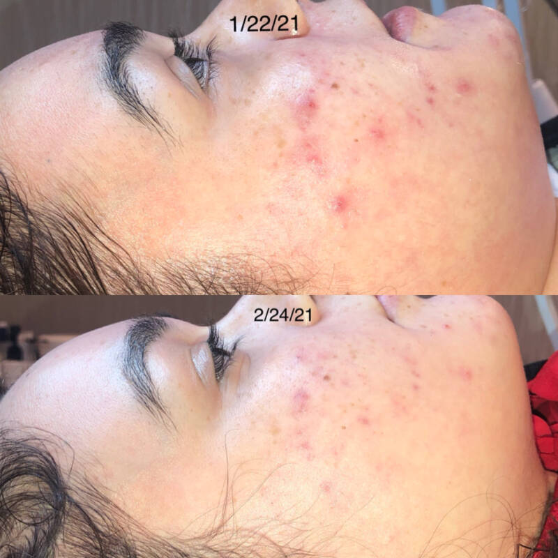 Before &amp; After 1 Chemical Peel