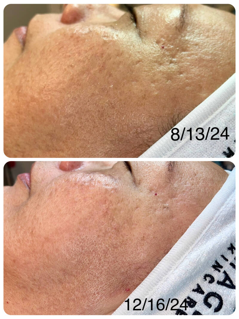 Before &amp; After 3 Micro-needling treatments