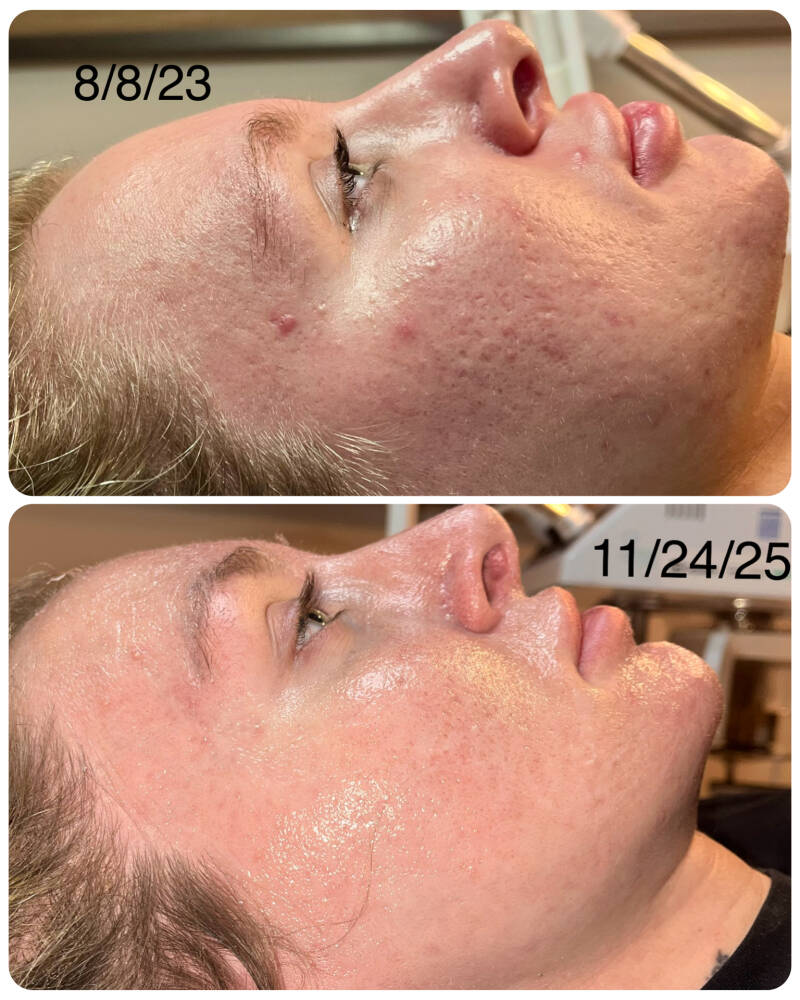 Before &amp; After 4 Micro-needling treatments