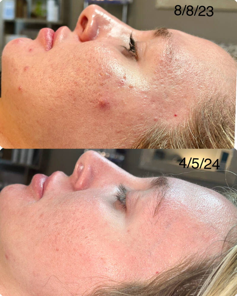 Before &amp; After 5 Micro-needling treatments