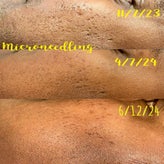 microneedling-j-before-and-after-standard.jpg