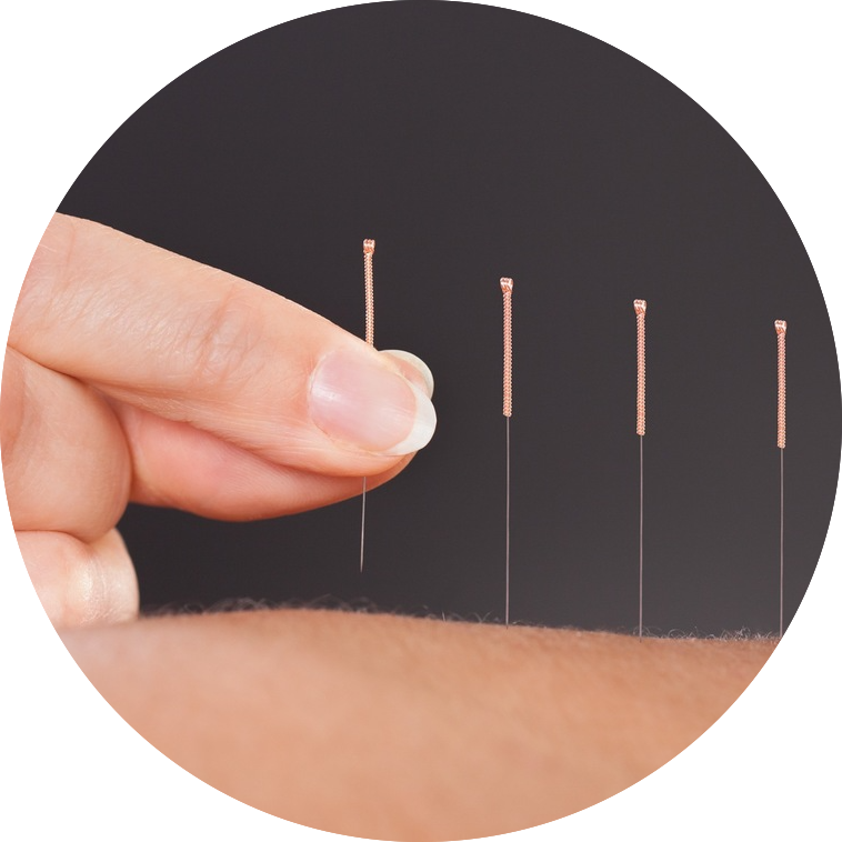 Trigger Point Dry Needling (TPDN) 