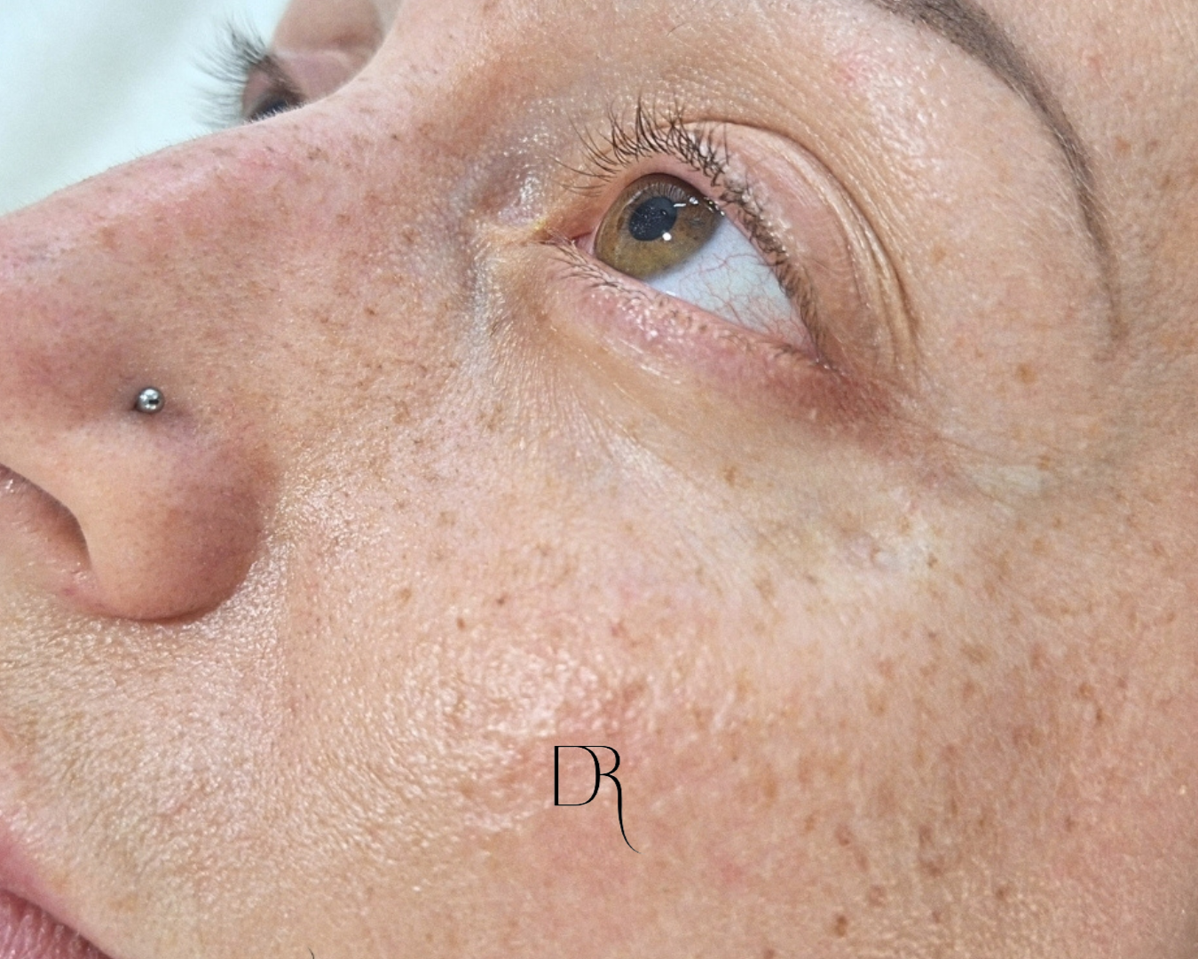 Taches de rousseur / Maquillage Permanent | Dermarose.ch