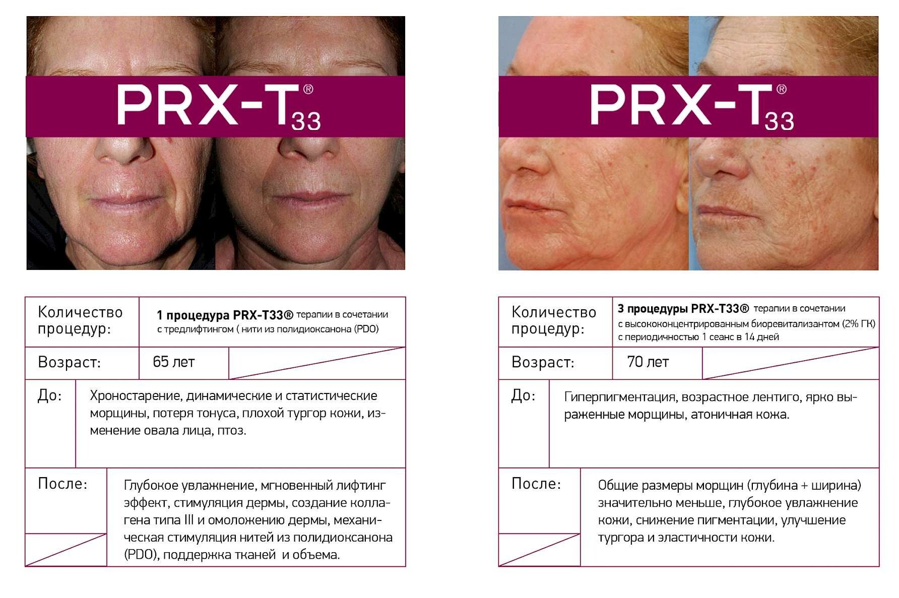 Prx T БИОРЕВИТАЛИЗАЦИЯ I PRX-T33 / РУССКИЙ | Silbermann Clinics
