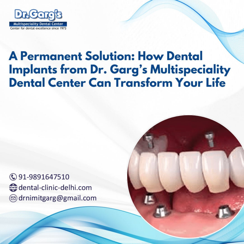 Dental implants