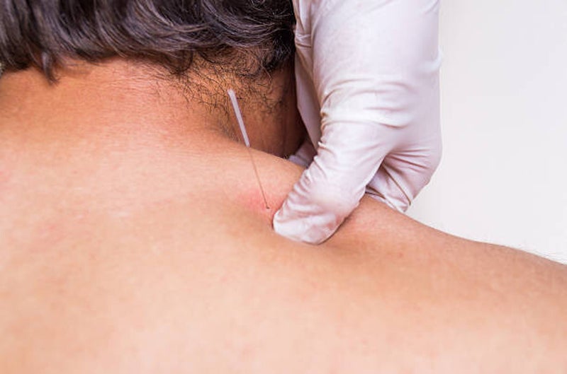 Dry Needling/Shoulder