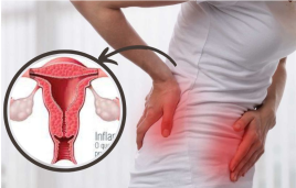 Douleurs mesntruelles, règles douleureuse