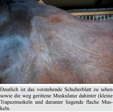 Muskelschwund beim Trapezmuskel