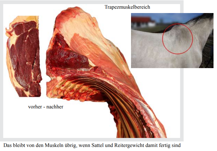 Muskelschwund beim Trapezmuskel