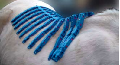 Muskelschwund beim Trapezmuskel