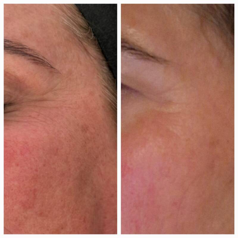 Voor de 1e Biopeeling vs Na de 3e biopeeling