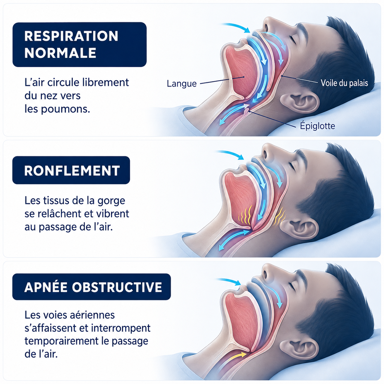 Schéma comparant respiration normale, ronflement et apnée obstructive du sommeil