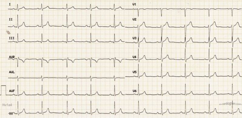 Électrocardiogramme ECG au cabinet de cardiologie à Paris 5e