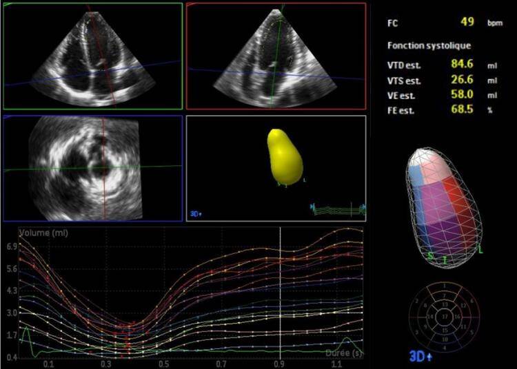 Échocardiographie transthoracique et mesure de la fonction cardiaque