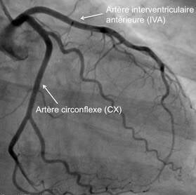 Image de coronarographie montrant l’artère interventriculaire antérieure et l’artère circonflexe