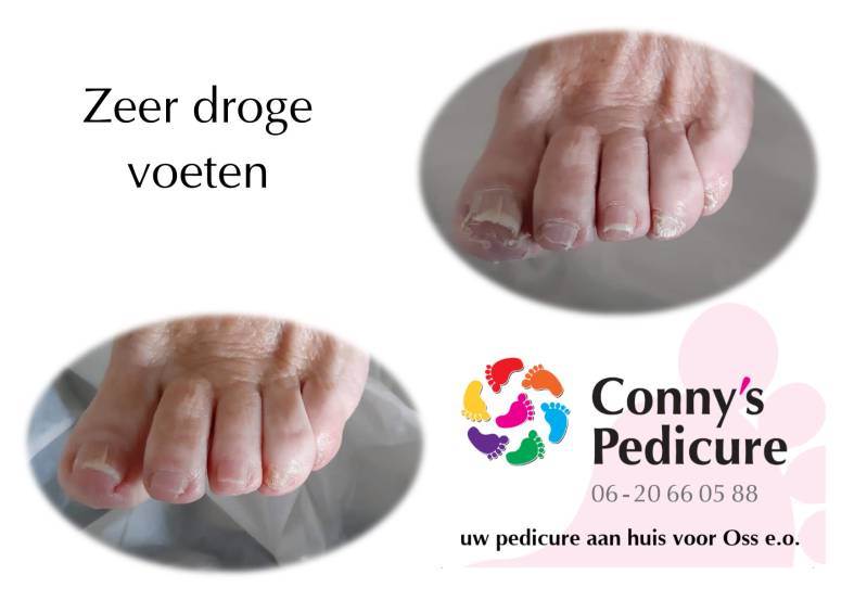 Zeer droge voeten