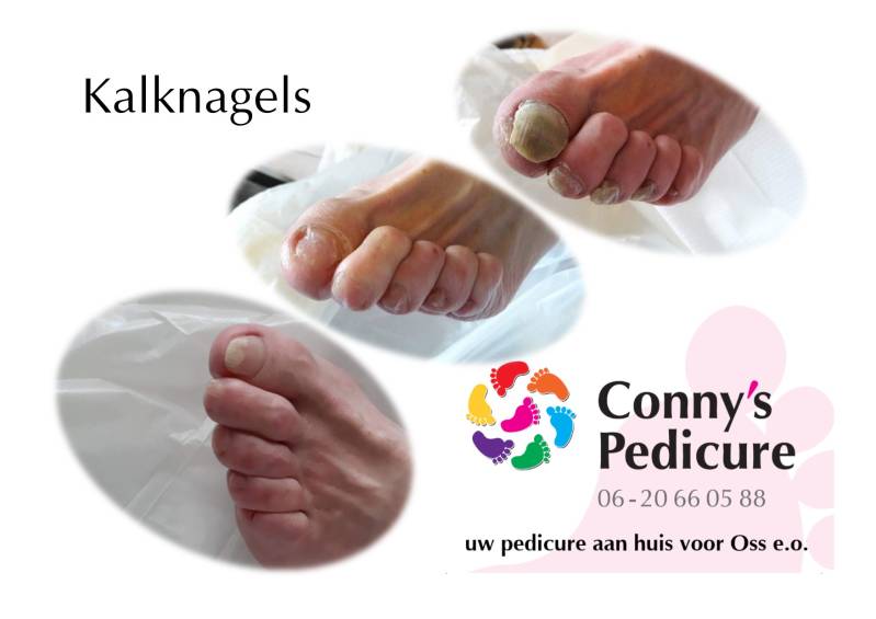 Kalknagels