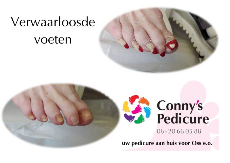 Verwaarloosde voeten