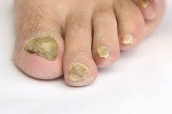 Pedicure behandeling van schimmelnagels (30 tot 40 minuten)