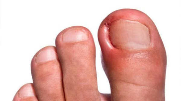 Pedicure spoedbehandeling (20 minuten) Alleen via een bel afspraak