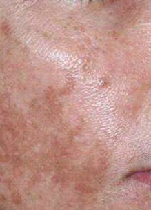 Microneedling schoonheidsbehandeling