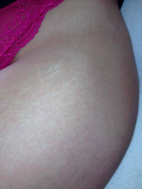 microneedling been behandeling