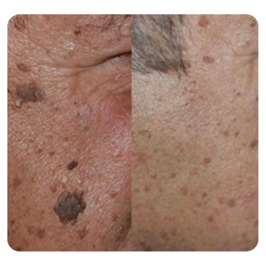 Ouderdomswrat verwijderen