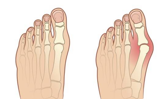 hallux valgus