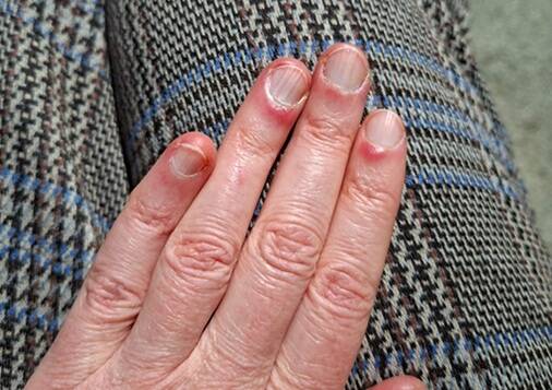 Sclerodermie symptomen handen en natuurlijke verlichting