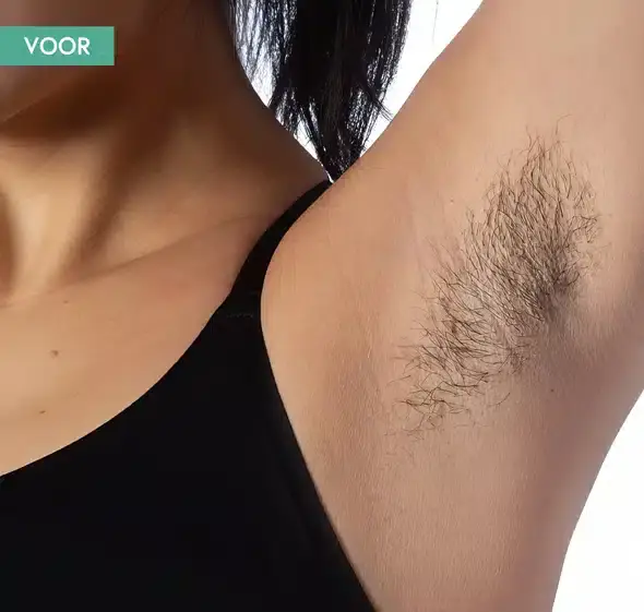 Voor de behandeling zie je normale okselbegroeiing