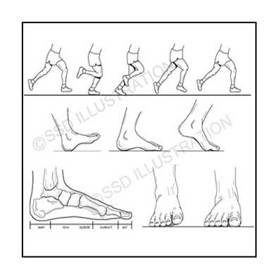 Patient education illustration showing foot bones and their positions during running and exercise, highlighting biomechanics and anatomical function.