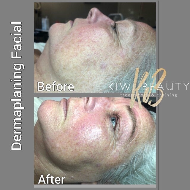 Dermaplaning and Chemical Peel