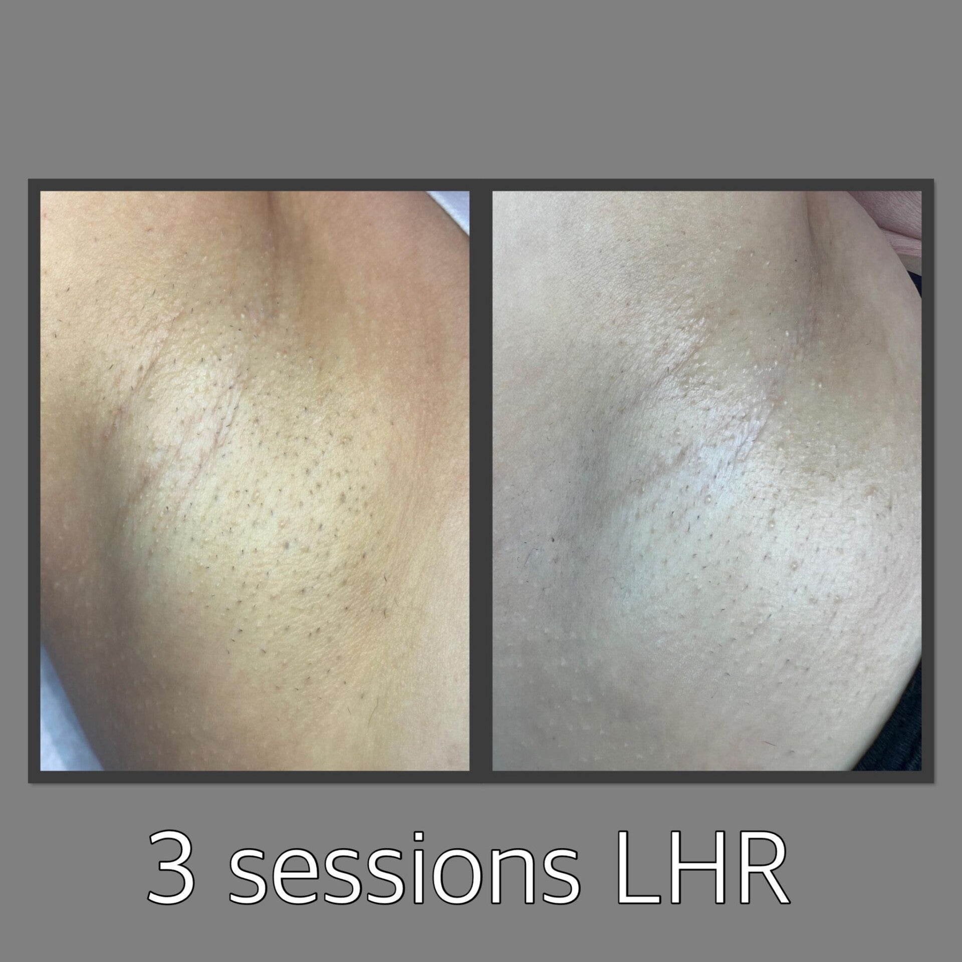 Laser Hair Reduction