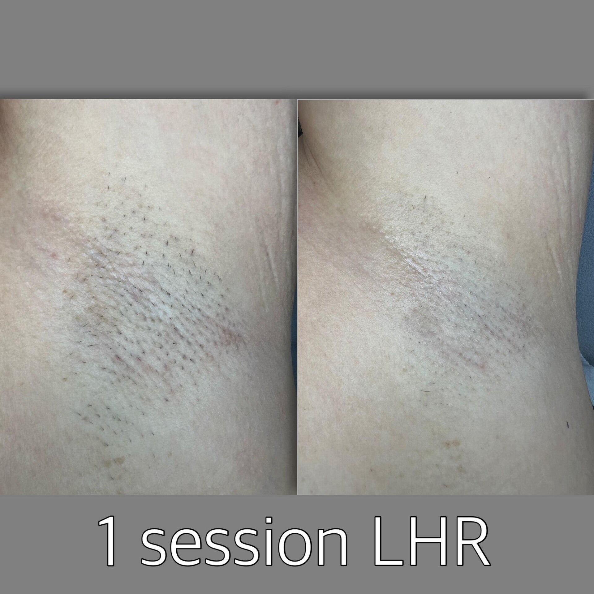 Laser Hair Reduction