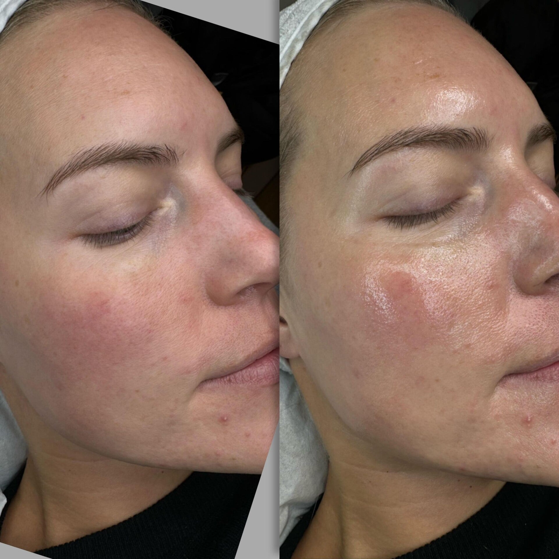 Microneedling