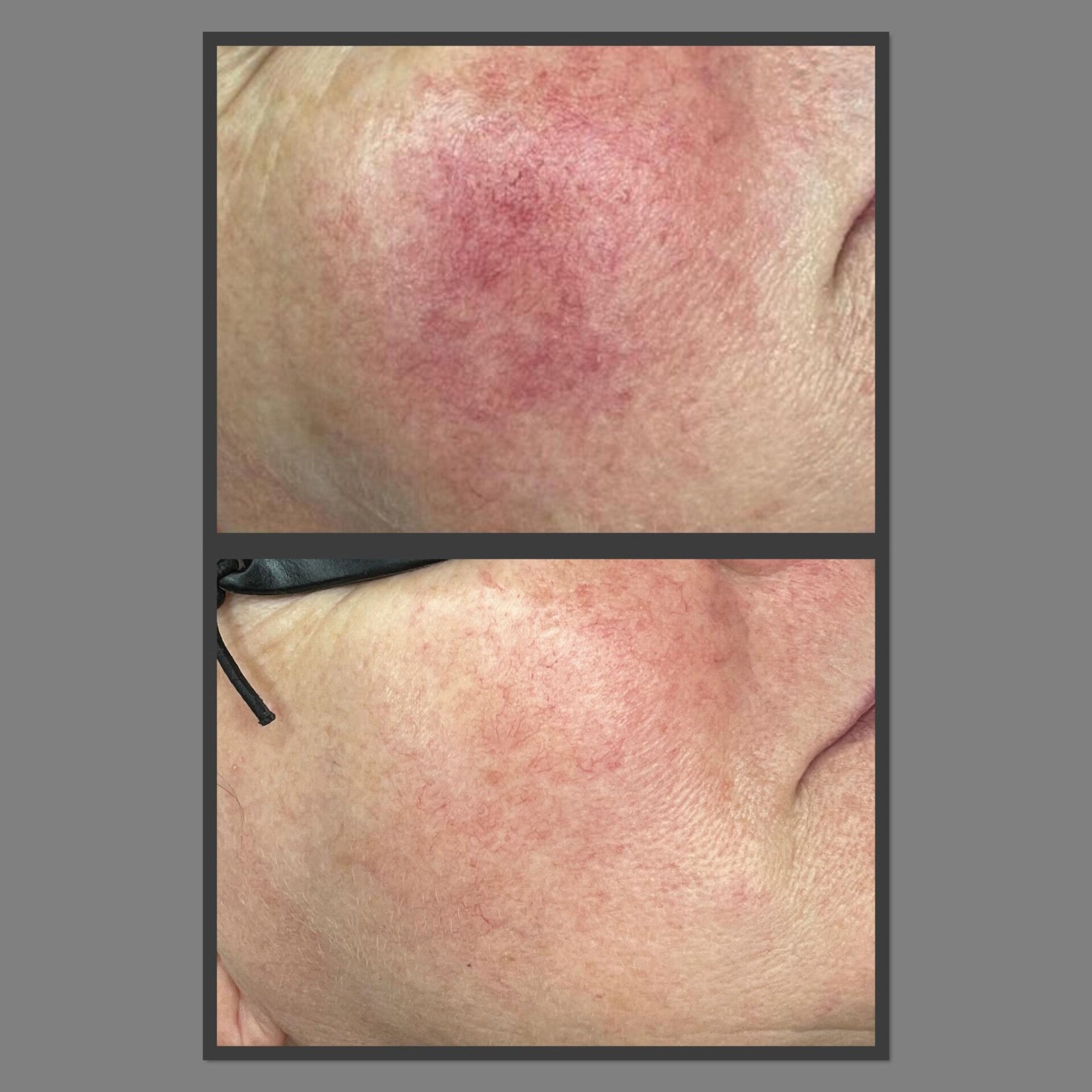 Spider Vein Treatment