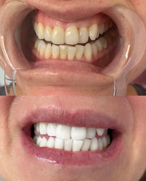 Cosmetic Teeth Whitening 60 minute custom session