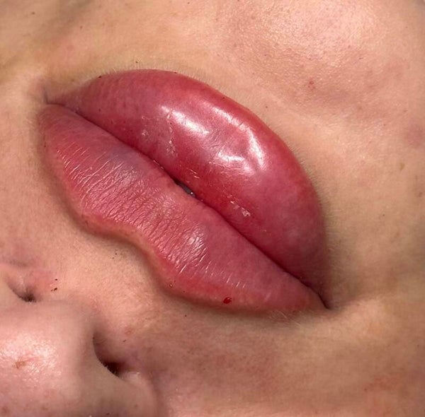 Lip Filler