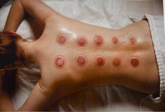 Cupping